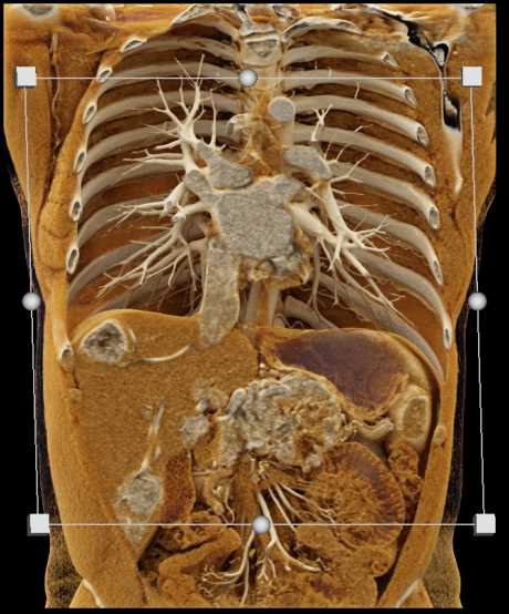 Pancreatic Neuroendocrine Tumor (PNET) Pancreas and Liver Metastases with Cinematic Rendering - CTisus CT Scan