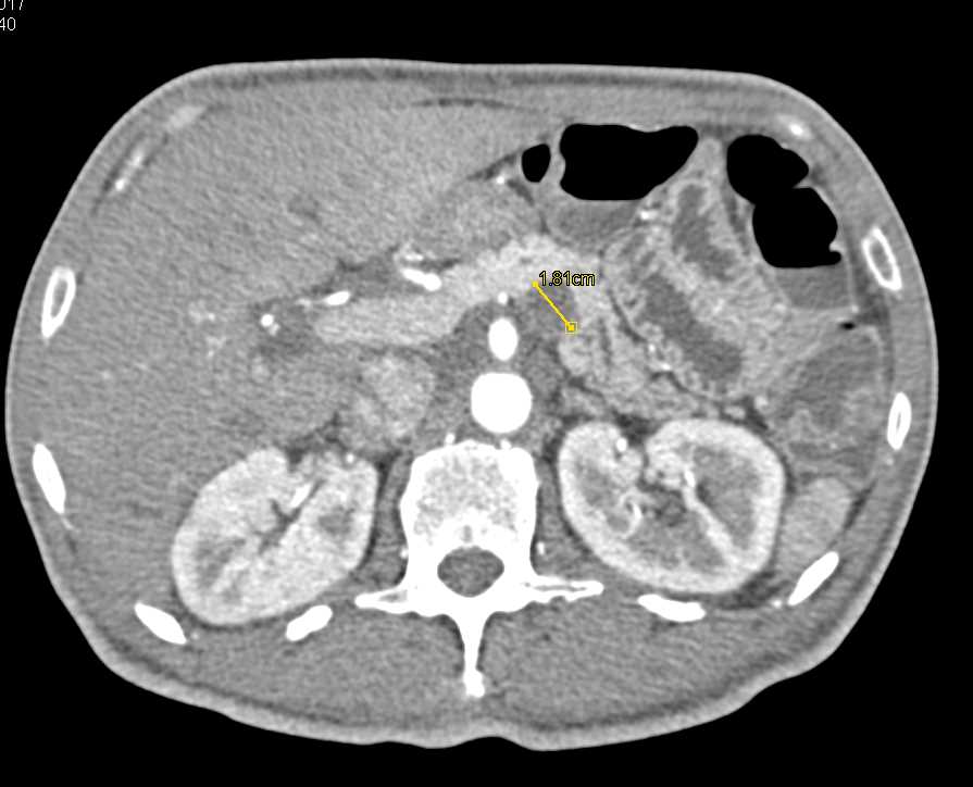 Intraductal Papillary Mucinous Neoplasm (IPMN) Body of Pancreas - CTisus CT Scan