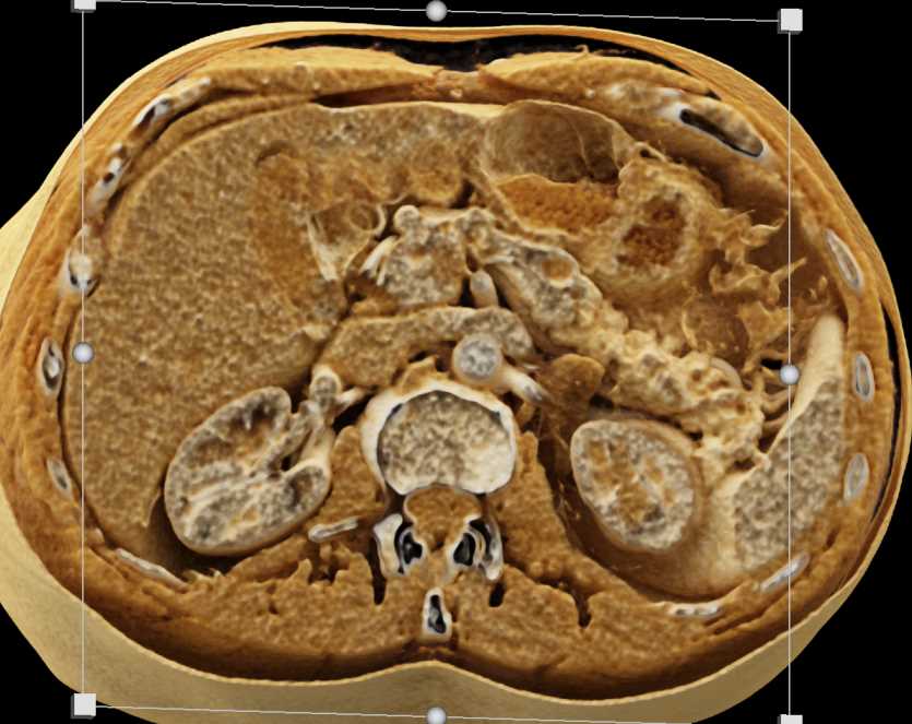 Neuroendocrine Tumor Pancreas with Cinematic Rendering - CTisus CT Scan