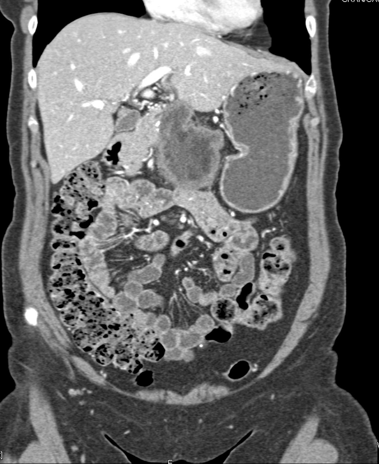 Omental Infarct Simulates Recurrent Pancreatic Cancer - CTisus CT Scan