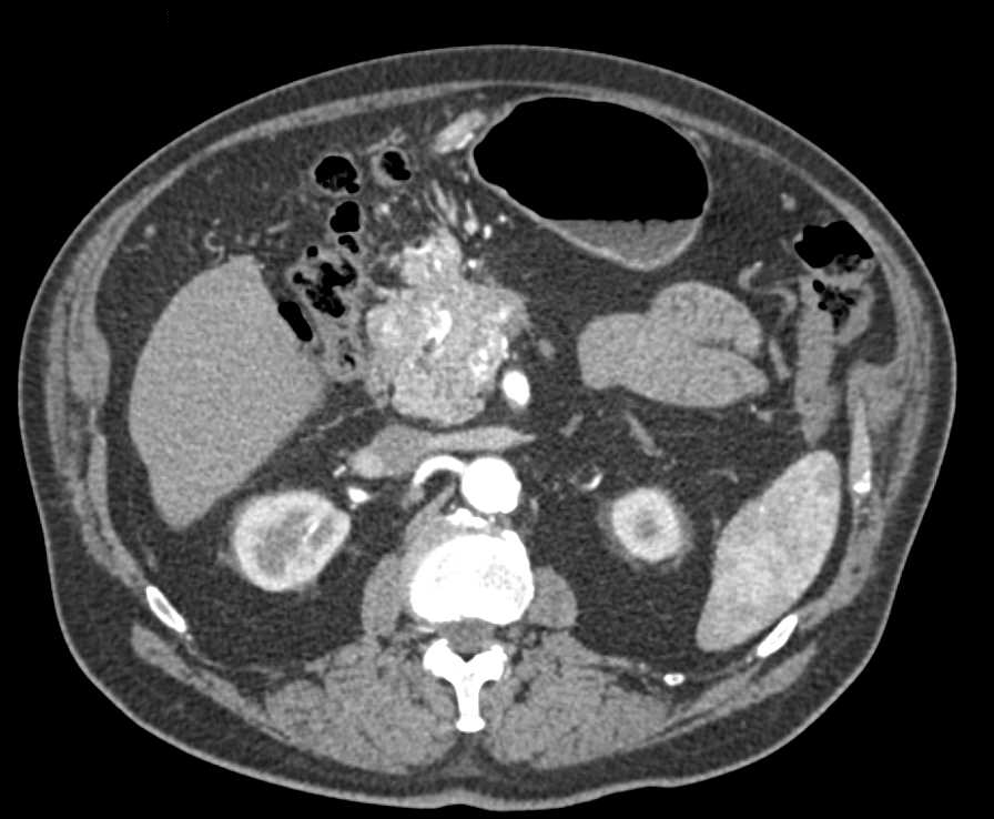 Pancreatic Adenocarcinoma with Venous Invasion - CTisus CT Scan