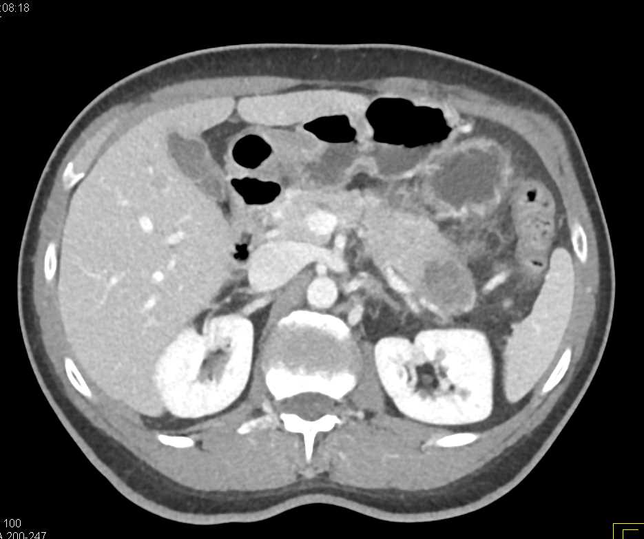 Carcinoma Tail of the Pancreas - CTisus CT Scan