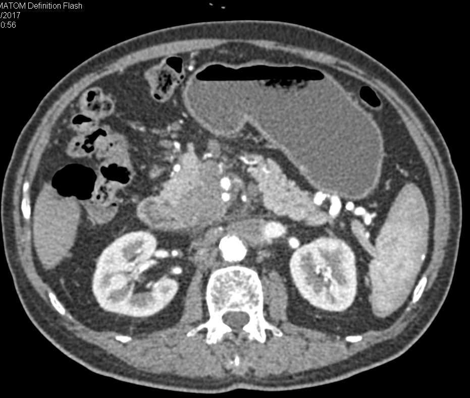 Pancreatic Adenocarcinoma with Superior Mesenteric Artery (SMA) and Superior Mesenteric Vein (SMV) Involvement - CTisus CT Scan