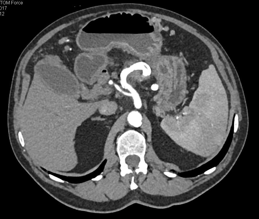 Carcinoma of the Pancreas with Cavernous Transformation of the Portal Vein (CTPV) - CTisus CT Scan