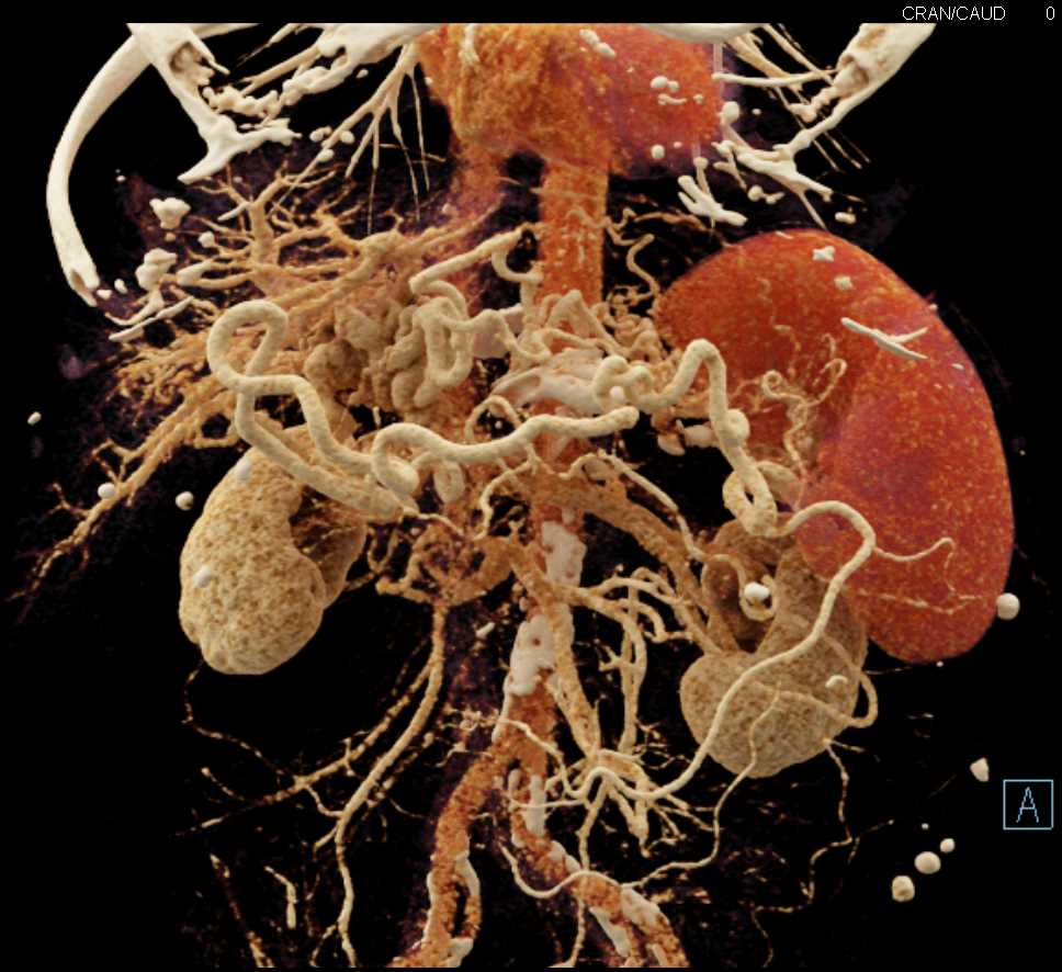 Carcinoma of the Pancreas with Cavernous Transformation of the Portal Vein (CTPV) with Cinematic Rendering - CTisus CT Scan