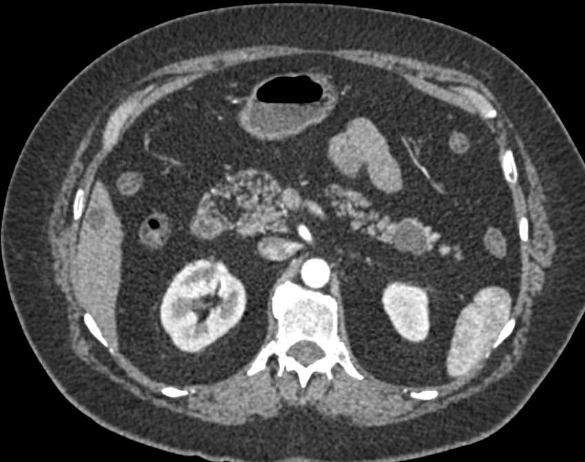 Intraductal Papillary Mucinous Neoplasm (IPMN) Tail of the Pancreas - CTisus CT Scan