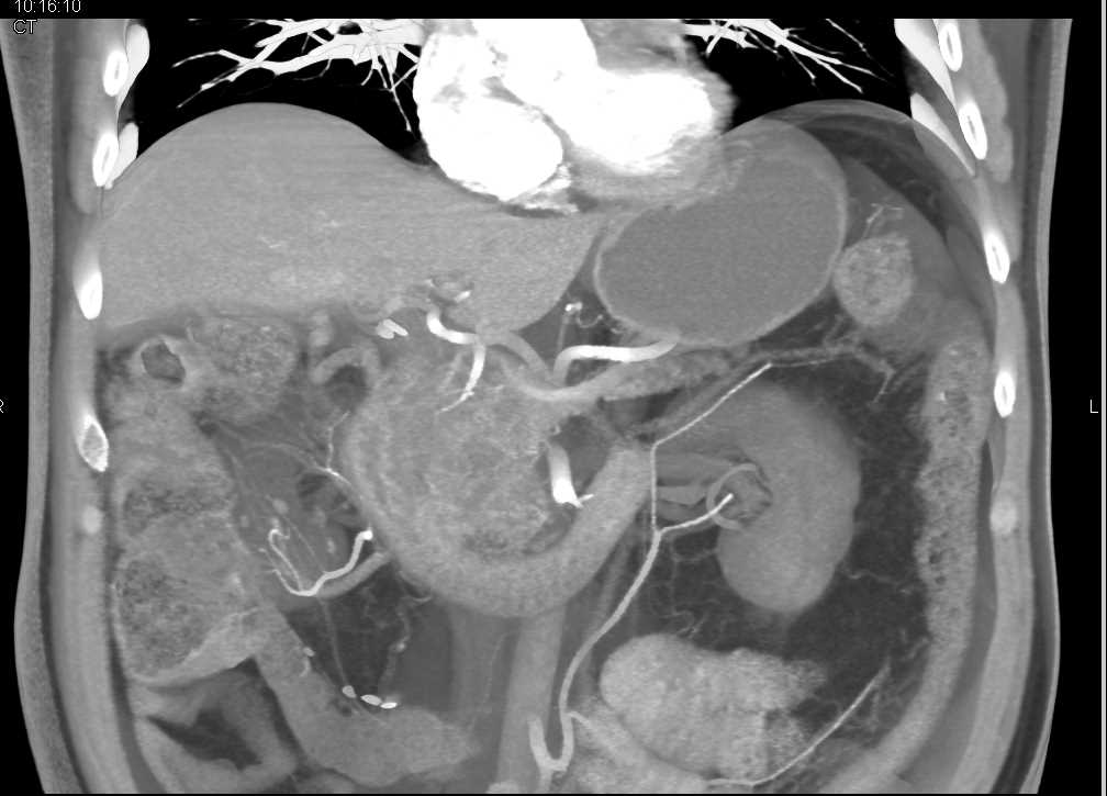 Groove Pancreatitis - CTisus CT Scan