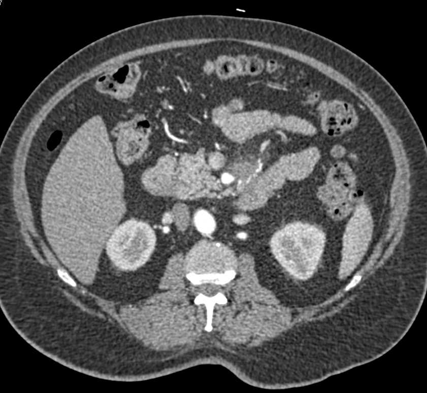 Pancreatic Cancer with Superior Mesenteric Artery (SMA) Encasement - CTisus CT Scan