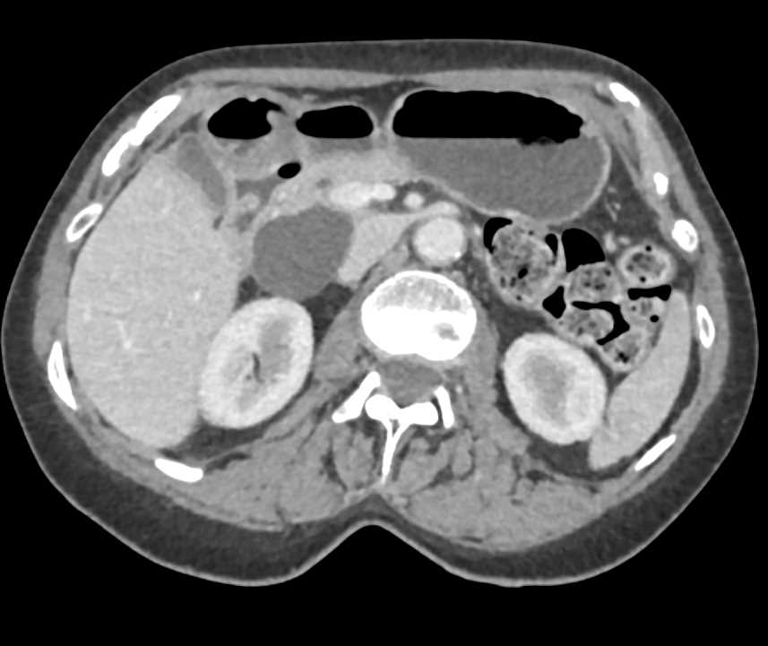 Intraductal Papillary Mucinous Neoplasm (IPMN) - CTisus CT Scan