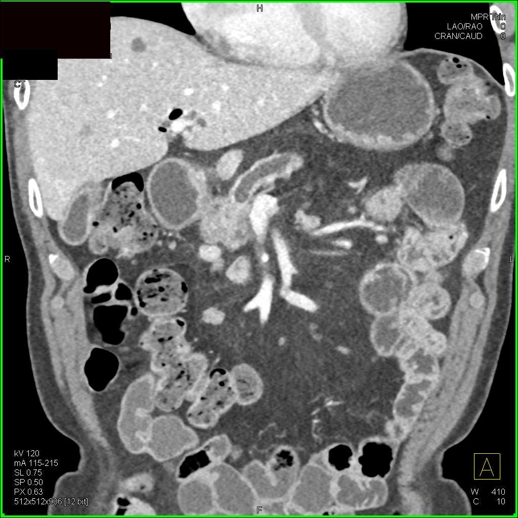 Adenocarcinoma Head of the Pancreas - CTisus CT Scan