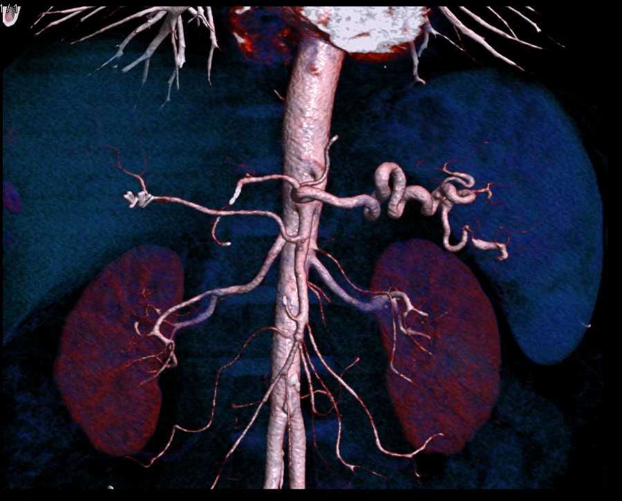 Adenocarcinoma Tail of Pancreas - CTisus CT Scan