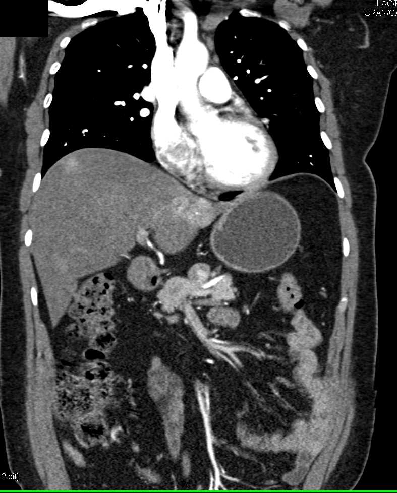 Adenocarcinoma of the Pancreas - CTisus CT Scan