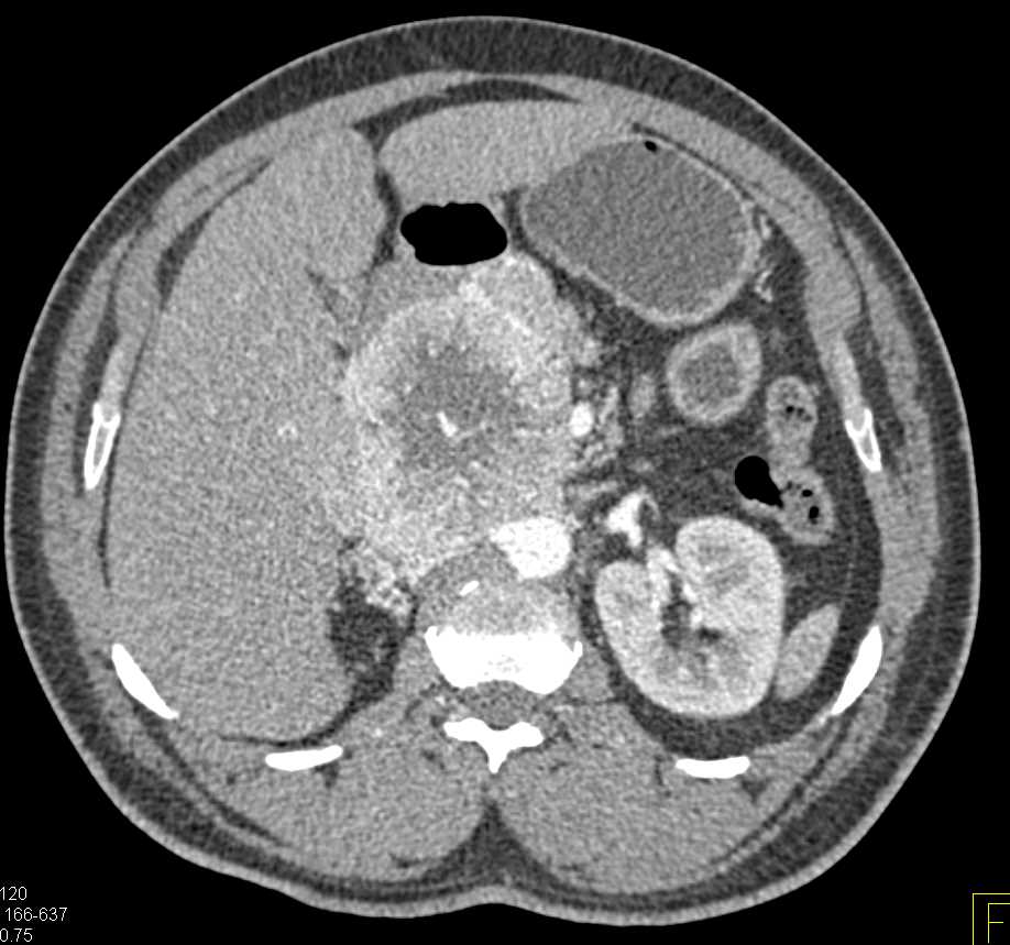 Neuroendocrine Tumor Pancreas - CTisus CT Scan