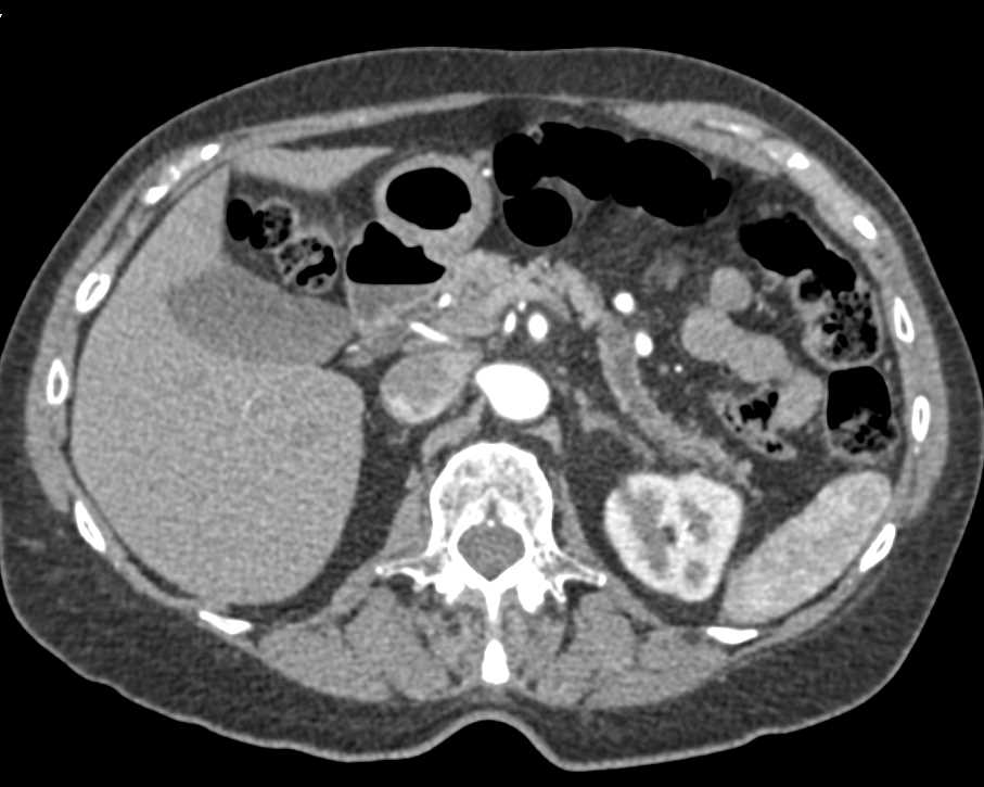 Pancreas Cancer with Dilated Pancreatic Duct - CTisus CT Scan