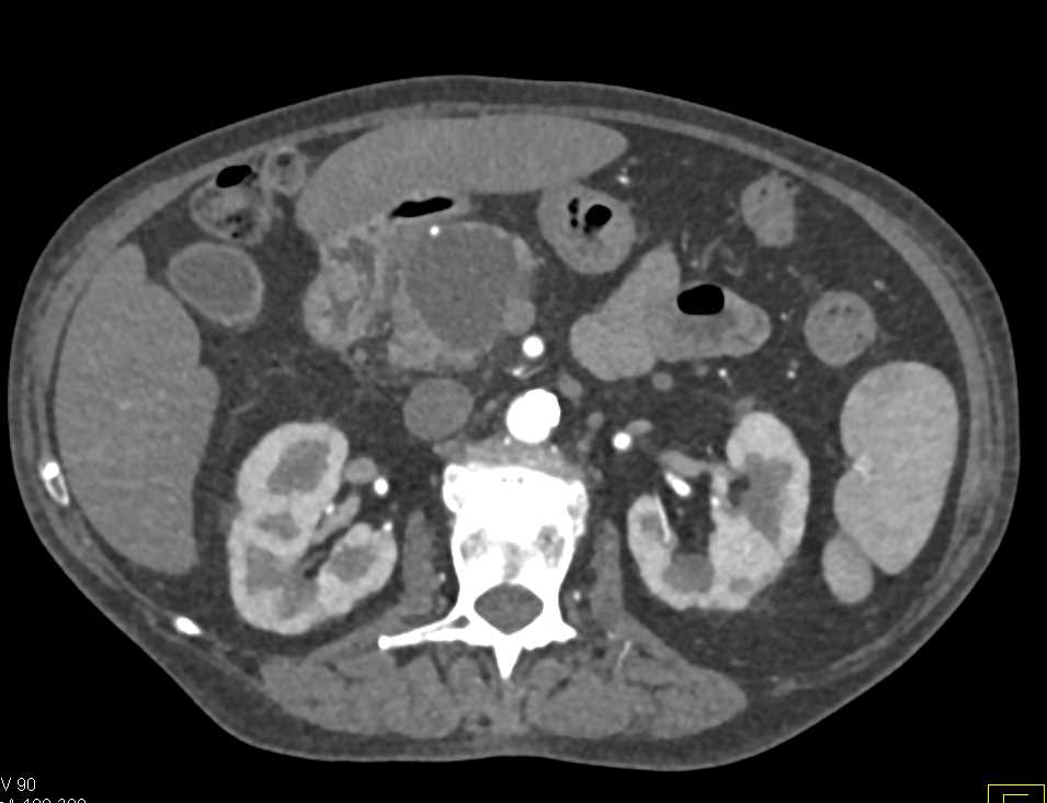 Intraductal Papillary Mucinous Neoplasm (IPMN) Head of Pancreas - CTisus CT Scan