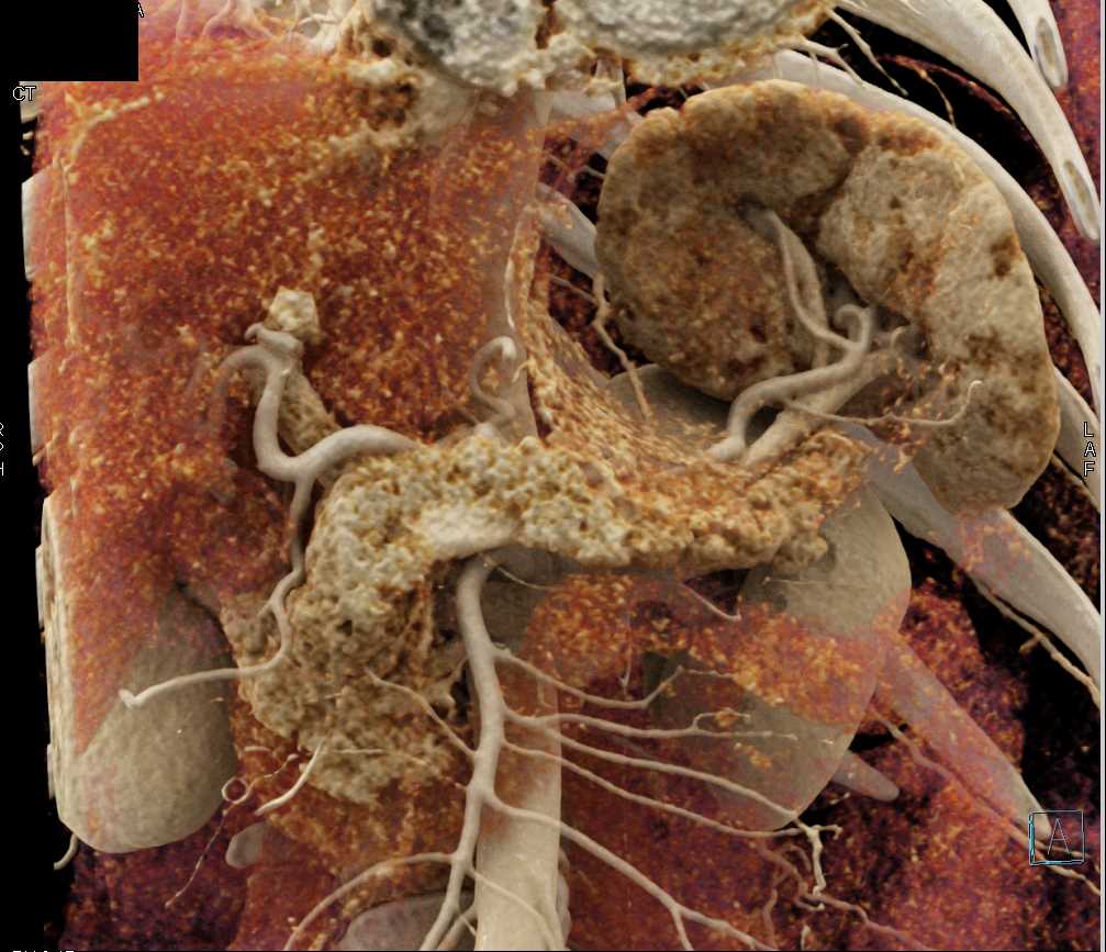 Normal Pancreas and Spleen with Cinematic Rendering - CTisus CT Scan