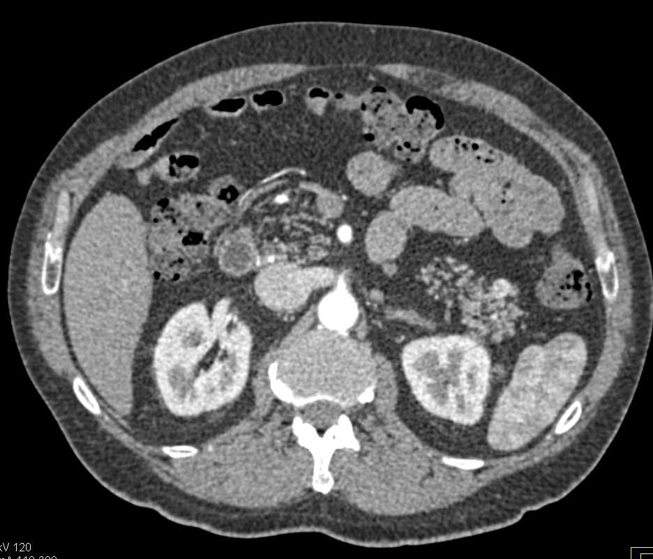 Pancreatic Neuroendocrine Tumor (PNET) Tail of Pancreas - CTisus CT Scan