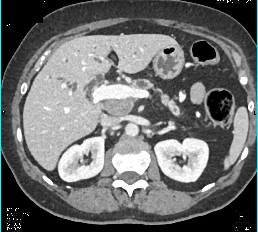 Pancreas Adenocarcinoma with Double Duct Sign - CTisus CT Scan