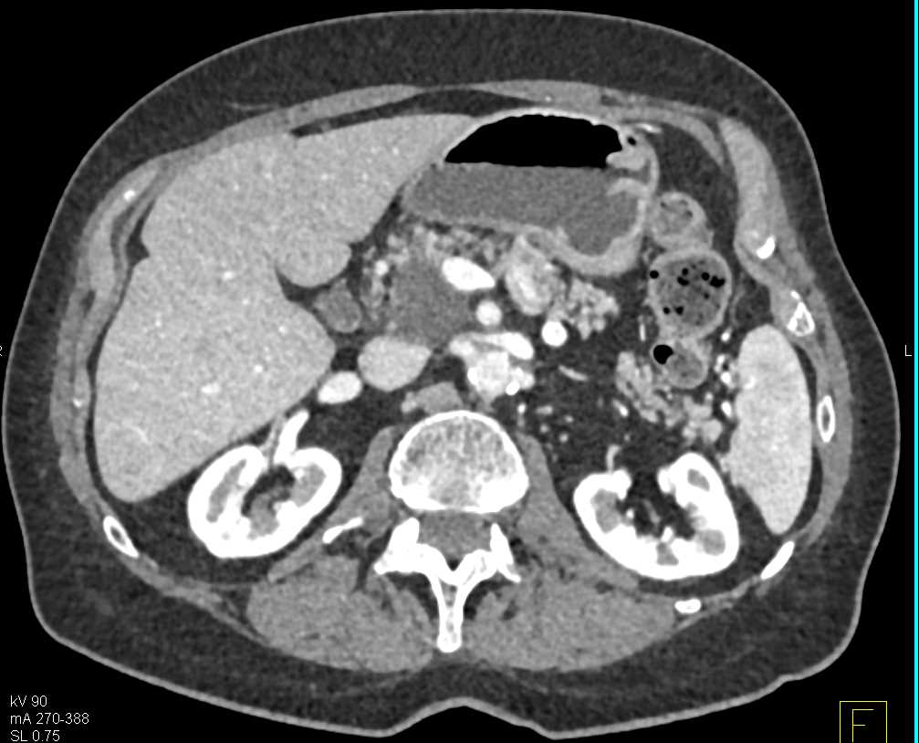 Intraductal Papillary Mucinous Neoplasm (IPMN) Head of Pancreas - CTisus CT Scan