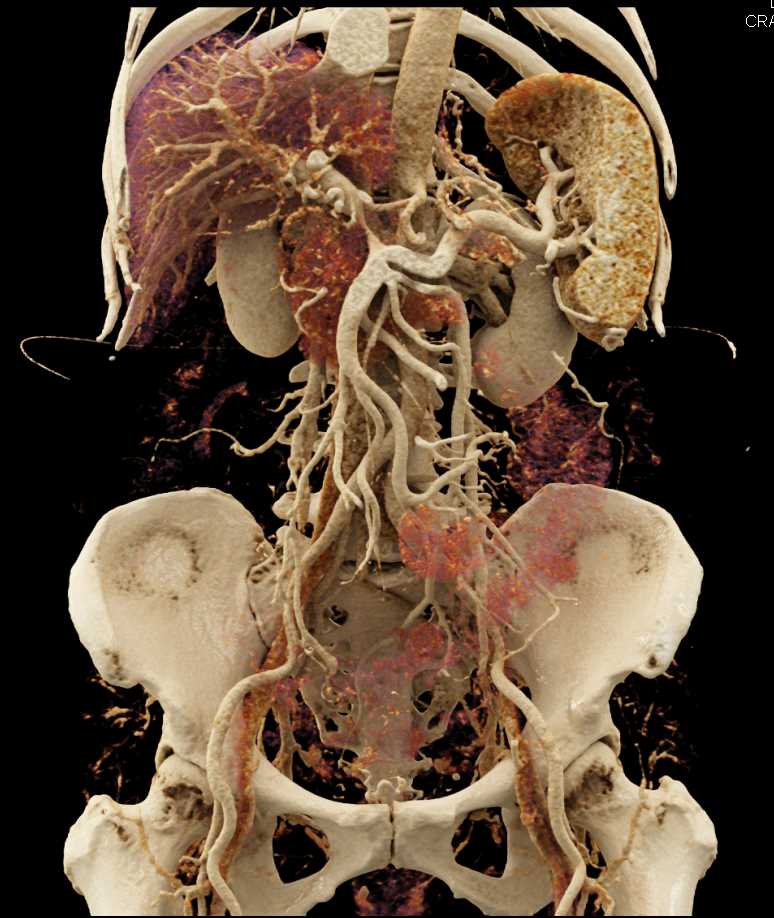 Pancreas Cancer Encases the Portal Vein with Cinematic Rendering - CTisus CT Scan