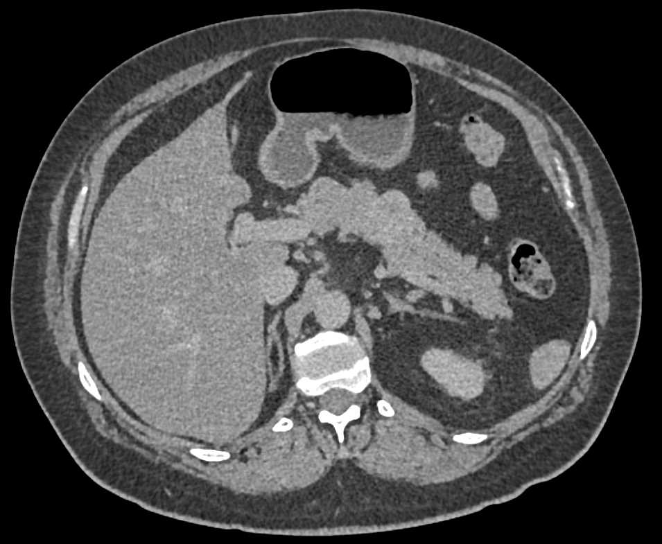 Metastatic Renal Cell Carcinoma to the Pancreas - CTisus CT Scan
