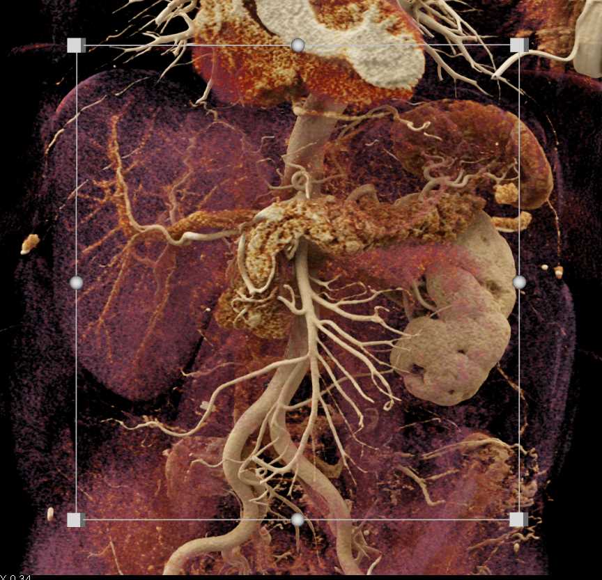 Carcinoma of the Pancreas - CTisus CT Scan
