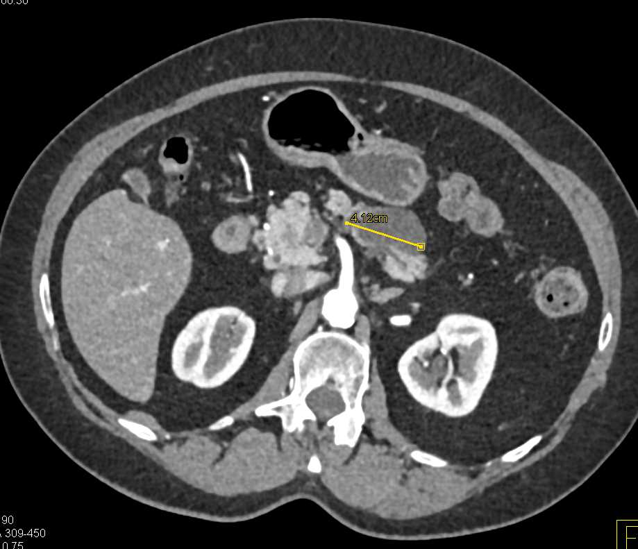Mixed Type Intraductal Papillary Mucinous Neoplasm (IPMN) - CTisus CT Scan