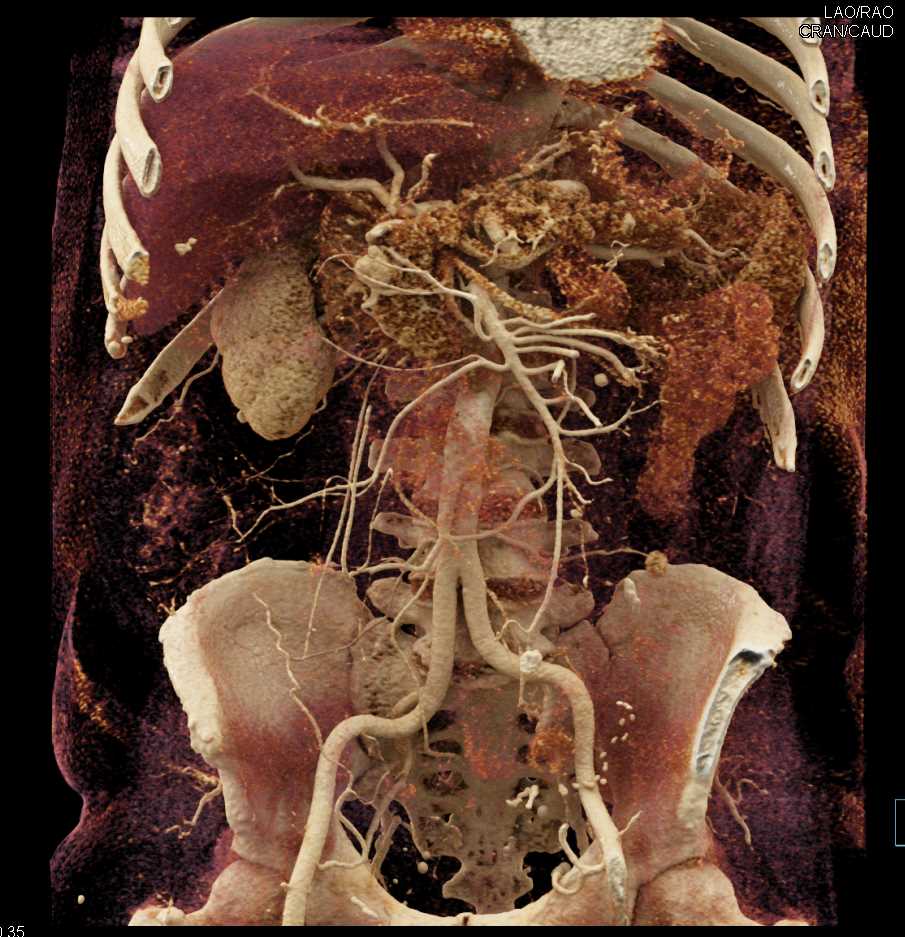 Metastatic Renal Cell Carcinoma to the Pancreas and Perirenal Space - CTisus CT Scan