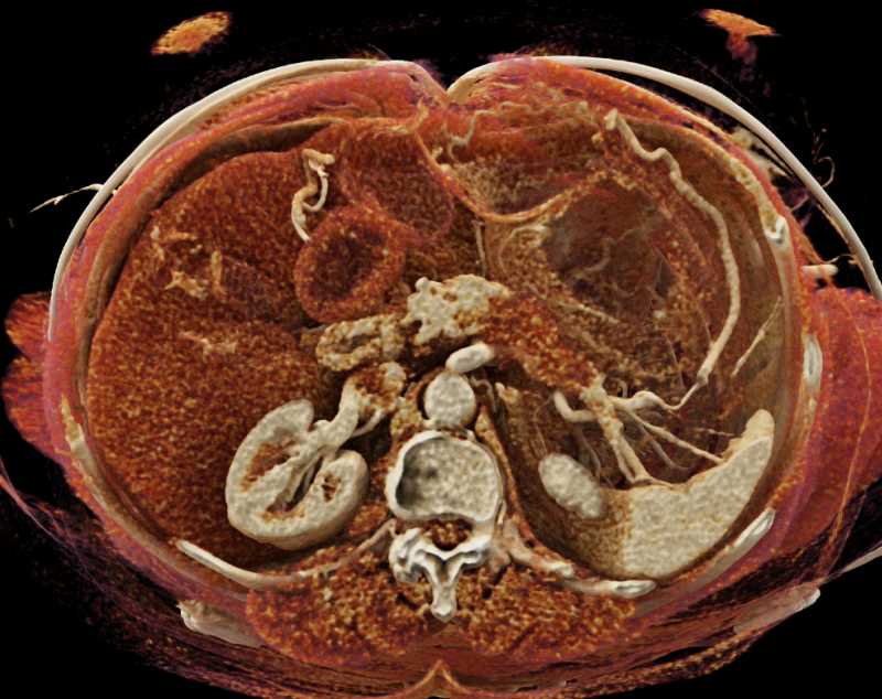Carcinoma Tail of the Pancreas - CTisus CT Scan