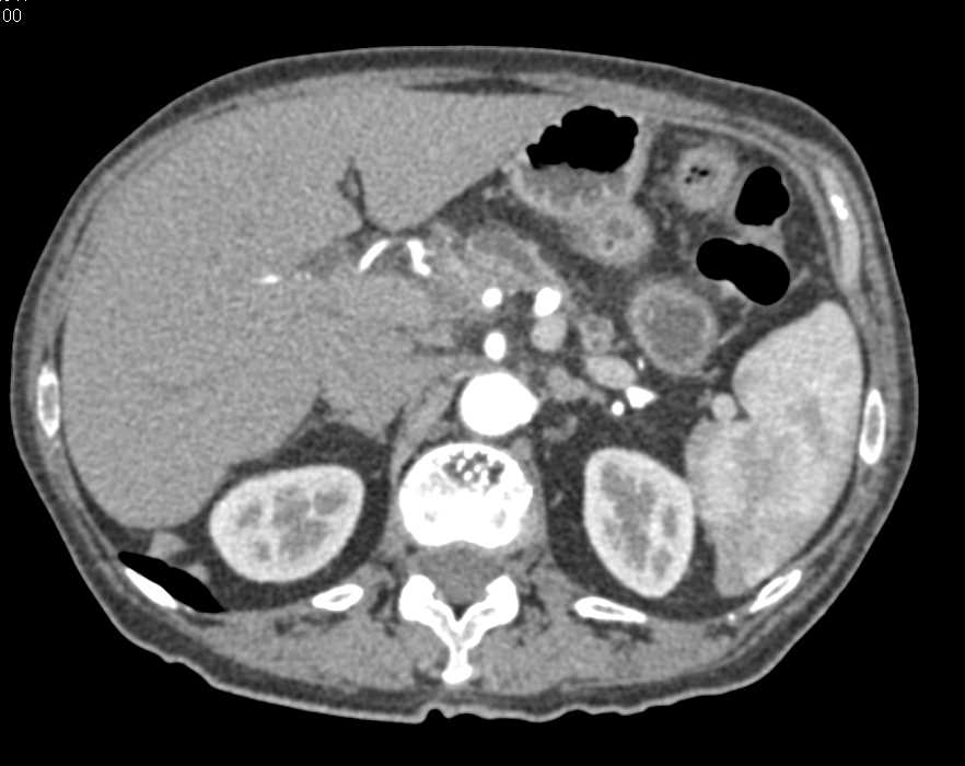 Carcinoma Body of the Pancreas - CTisus CT Scan