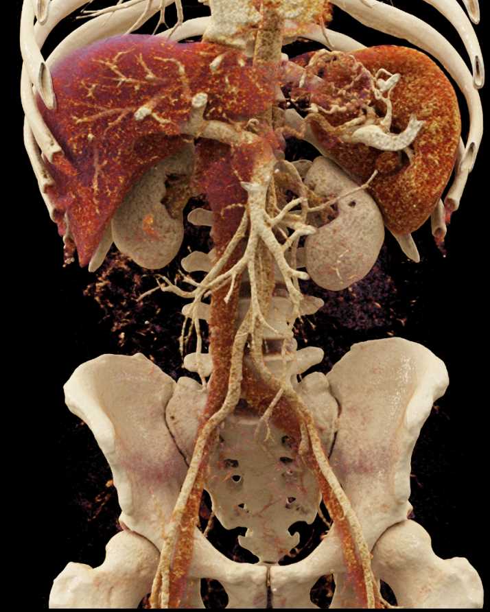 Carcinoma Tail of Pancreas with Vascular Collaterals - CTisus CT Scan