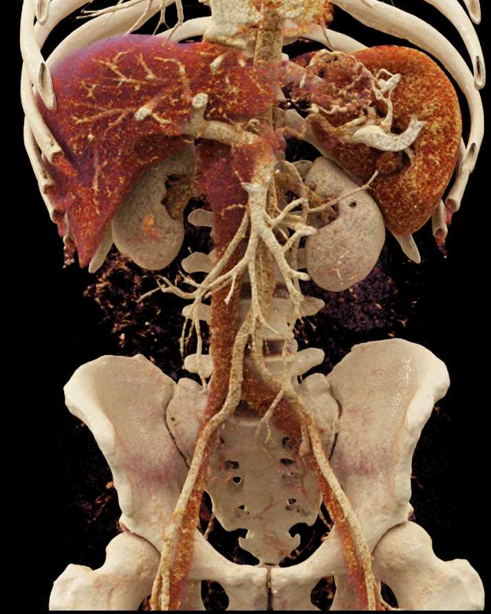 Carcinoma Tail of Pancreas with Vascular Collaterals - CTisus CT Scan