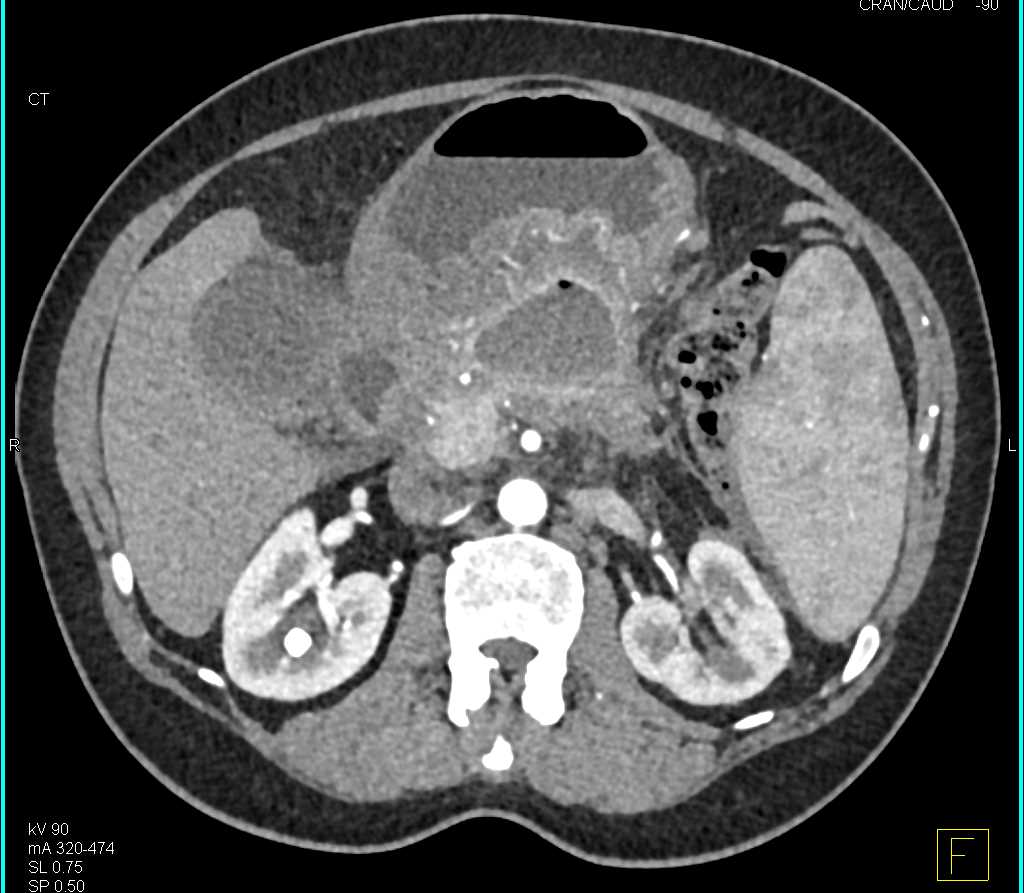 Pancreatitis with Abscess and Vascular Involvement - CTisus CT Scan