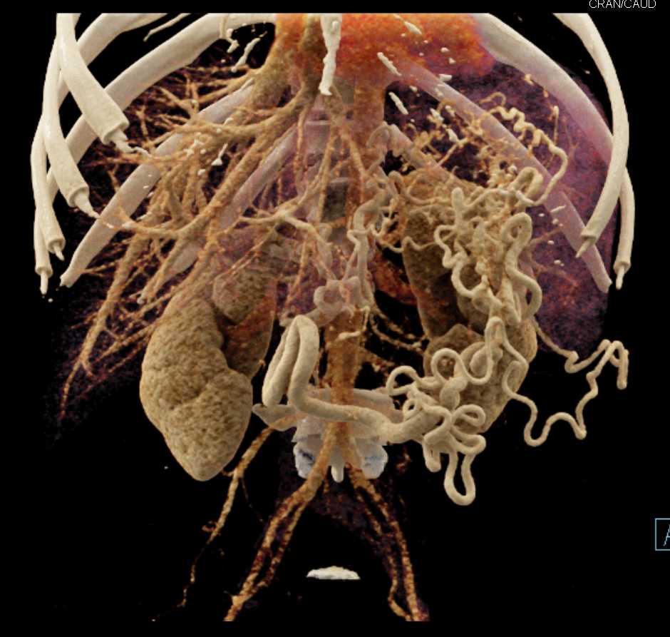Pancreatitis with Abscess and Vascular Involvement - CTisus CT Scan