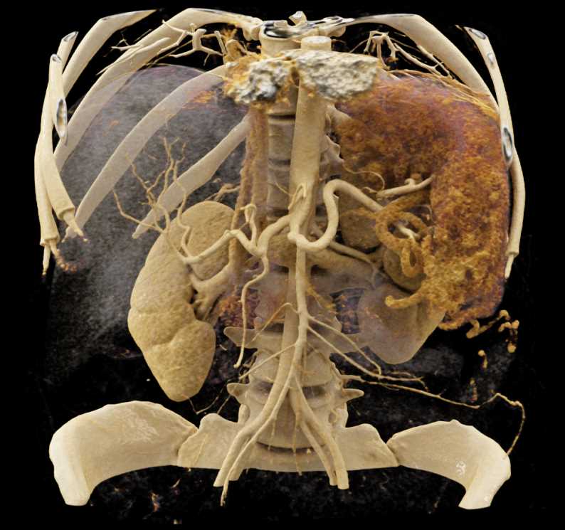 Vascular Collaterals due to Portal Vein Involvement - CTisus CT Scan