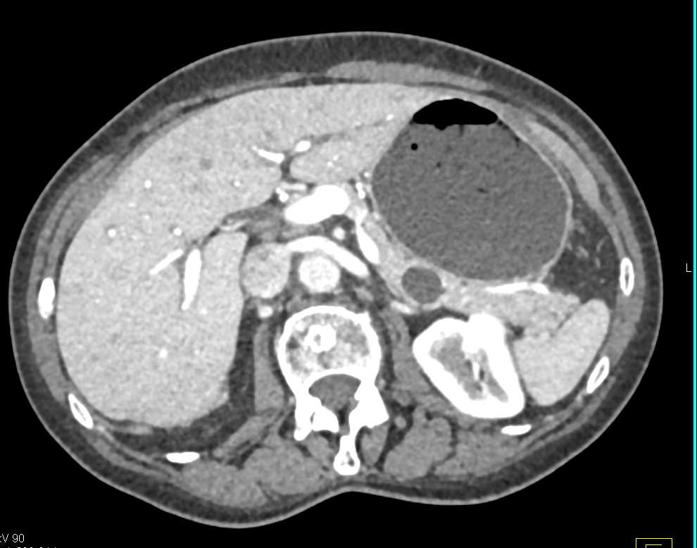 Intraductal Papillary Mucinous Neoplasm (IPMN) Tail of Pancreas - CTisus CT Scan