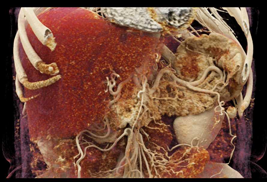 Vascular Mapping of the Pancreas and Liver - CTisus CT Scan