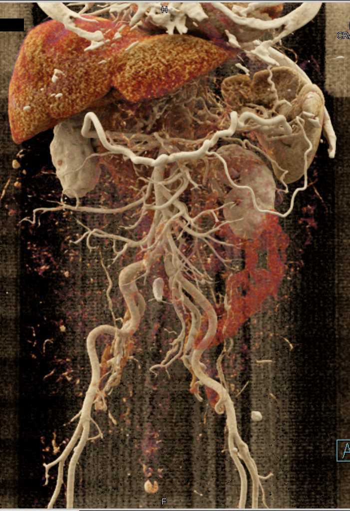 Collateral Pathways due to Invasive Pancreatic Adenocarcinoma - CTisus CT Scan