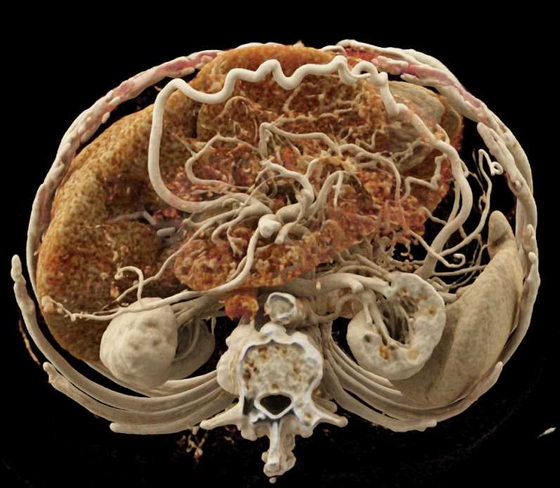 Collateral Pathways due to Invasive Pancreatic Adenocarcinoma Best Seen by PV/SMV - CTisus CT Scan