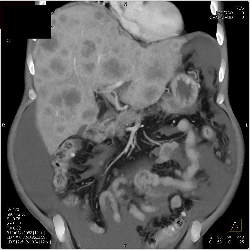 Carcinoma Tail of Pancreas with Carcinomatosis - CTisus CT Scan