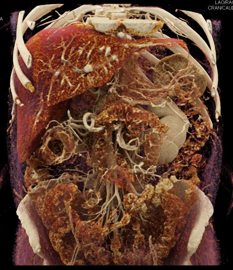 Subtle Pancreatic Cancer with Dilated Pancreatic Duct - CTisus CT Scan