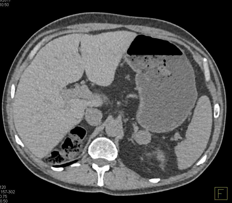 Metastatic Renal Cell Carcinoma to the Pancreas - CTisus CT Scan