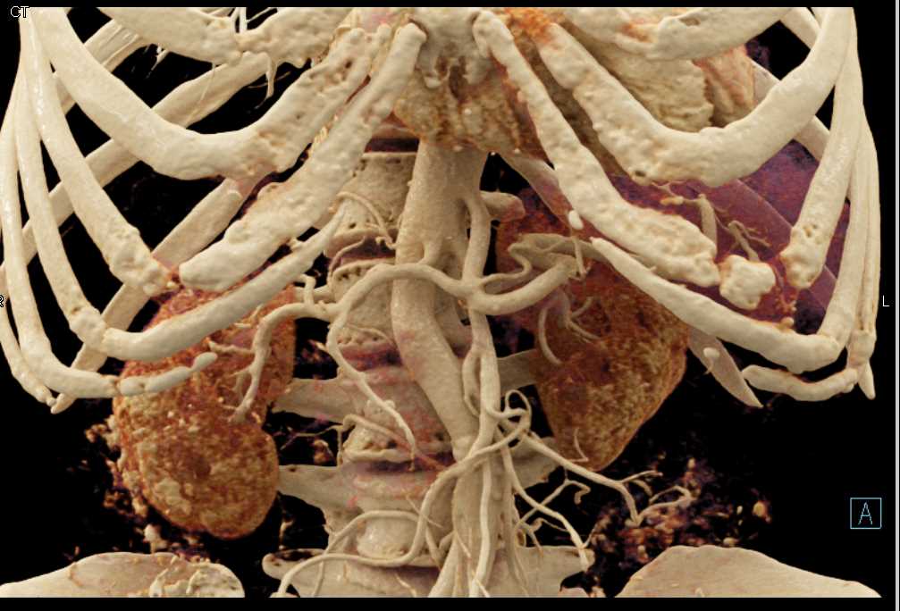 Serous Cystadenoma - CTisus CT Scan