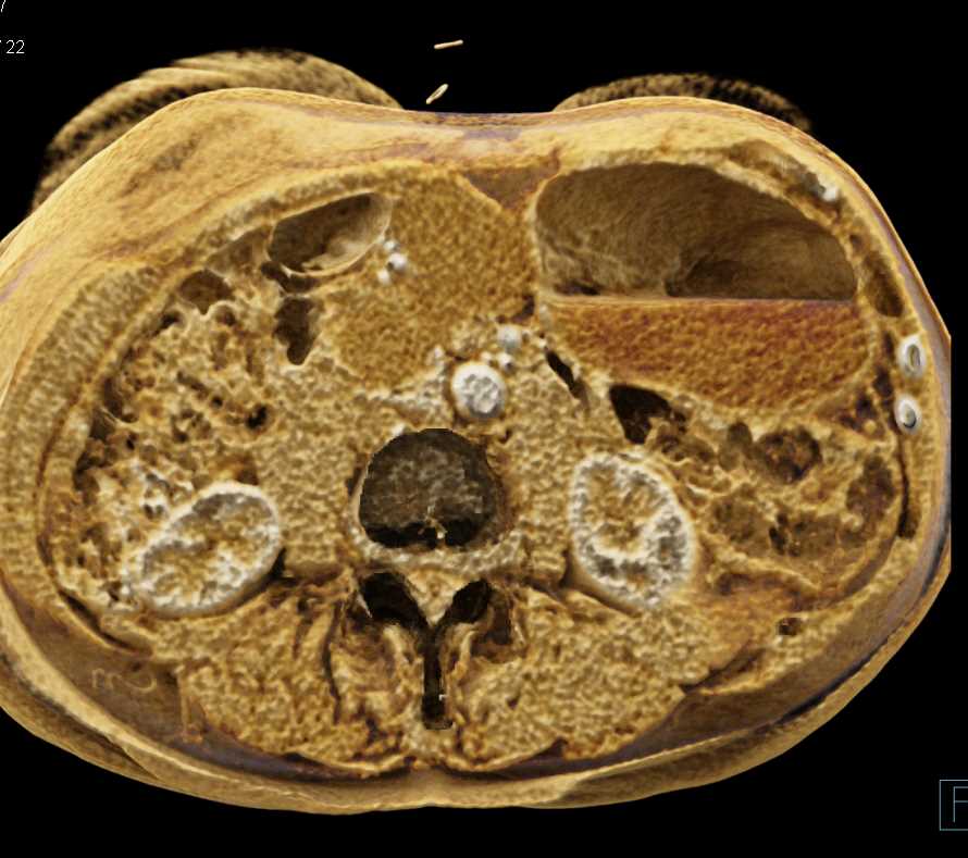 Serous Cystadenoma - CTisus CT Scan