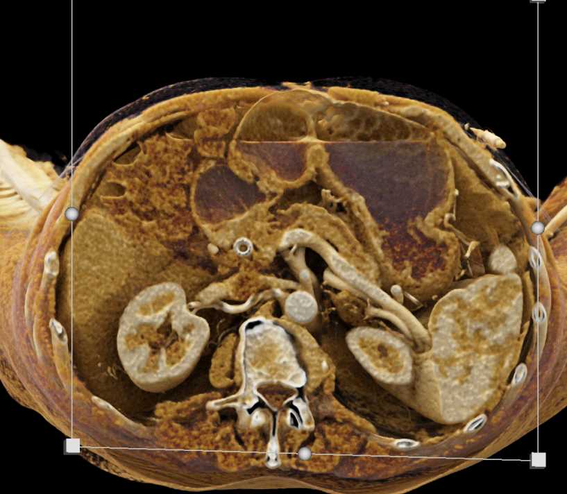 Pancreas Adenocarcinoma with Cinematic Rendering - CTisus CT Scan