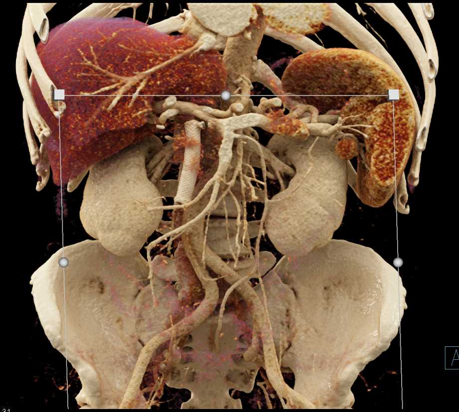 Pancreatic Adenocarcinoma with Stent in the Common Bile Duct (CBD) with Cinematic Rendering - CTisus CT Scan
