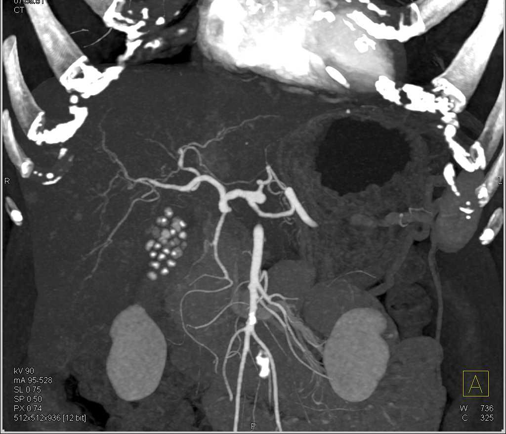 Carcinoma Body of the  Pancreas Invades the PV-SMV Confluence - CTisus CT Scan