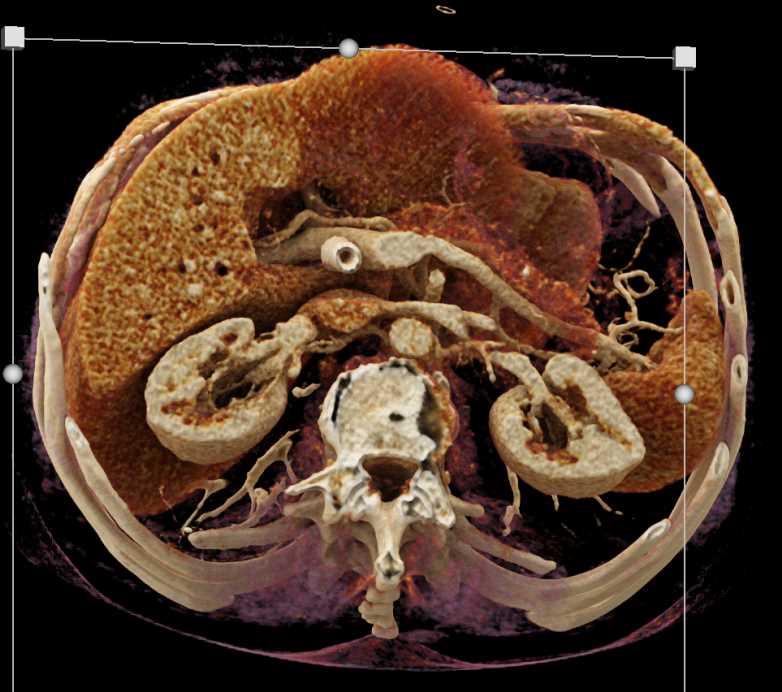 Ampullary Cancer in a Patient with Chronic Pancreatitis and Common Bile Duct (CBD) Stent and Cinematic Rendering - CTisus CT Scan