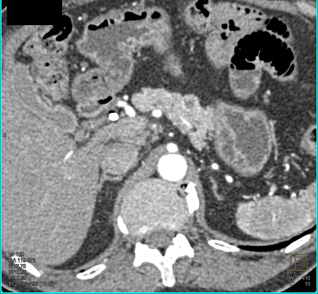 Cystic Pancreatic Neuroendocrine Tumor (PNET) Body of the Pancreas - CTisus CT Scan