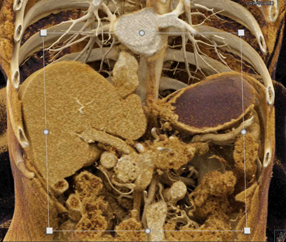 Pancreatic Adenocarcinoma Encases the Celiac and the Superior Mesenteric Artery (SMA) with Cinematic Rendering - CTisus CT Scan